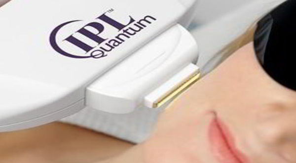 IPL Quantum Lumenis — usuwanie przebarwien